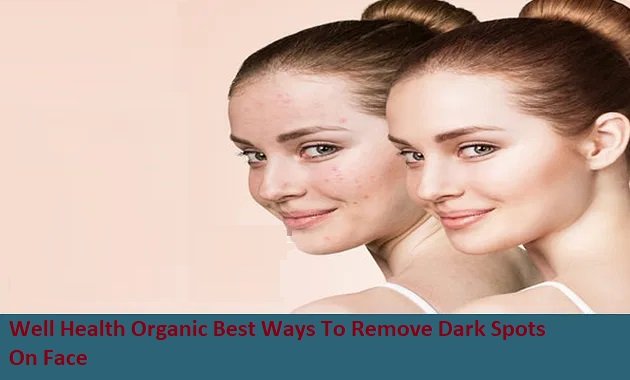Well Health Organic Best Ways To Remove Dark Spots On Face